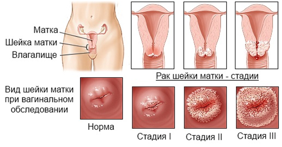 Как диагностировать и остановить рак. 5 ценных советов