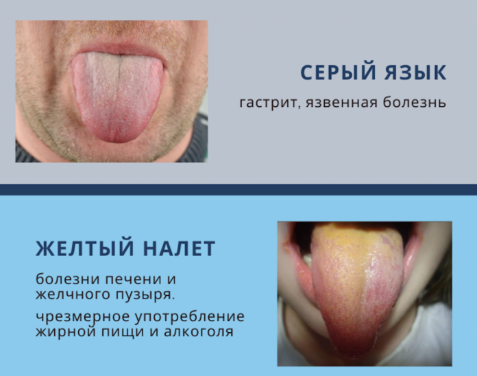 kak-opredelit-bolezn-po-tsvetu-yazyka