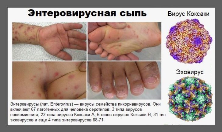 Новая болезнь: какие опасные осложнения может вызвать энтеровирус